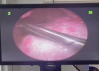 Trung tâm Y tế huyện CưJut thực hiện thành công ca hóc dị vật ở trẻ